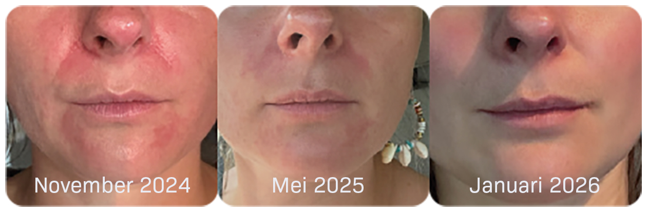 Gevoelige Huid Zeewier hormonen